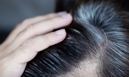 The cause of premature gray hair, Why does it happen at a young age?
